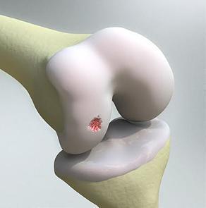 Bioploy implants